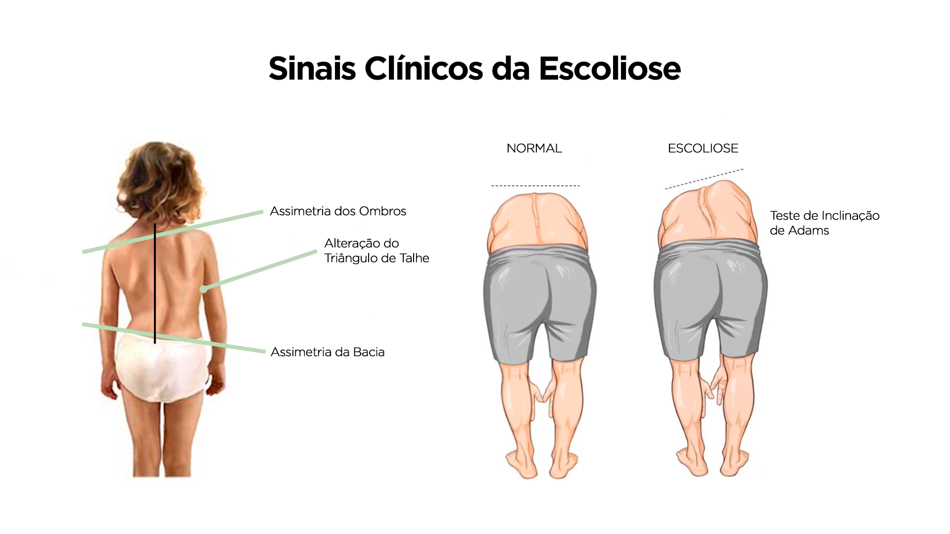 O primeiro diagnóstico da escoliose é clínico e feito em consultório.