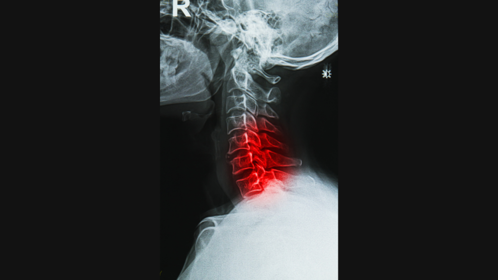 Raio-X da coluna cervical com destaque em região afetada por estenose